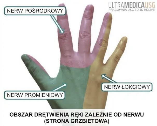 Drętwienie dłoni w ciąży – przyczyny i skuteczne sposoby na ulgę