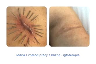 Szycie po porodzie: ile trwa gojenie i jak zadbać o ranę?