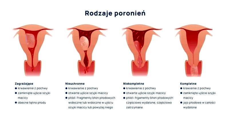 Wczesne poronienie: objawy i sygnały alarmowe — kiedy zgłosić się do lekarza